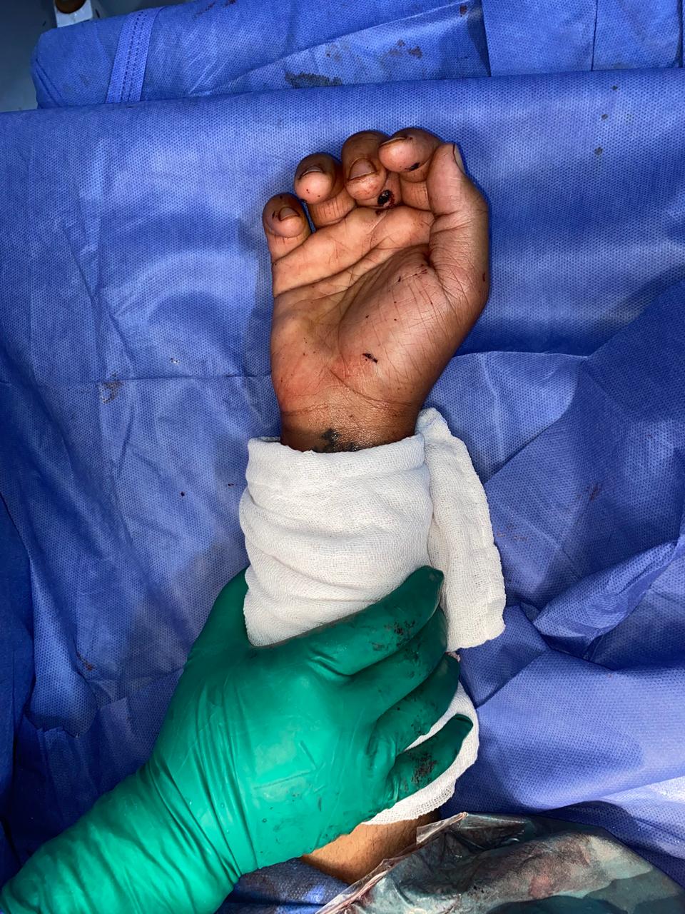 إعادة الذراع مرة أخرى