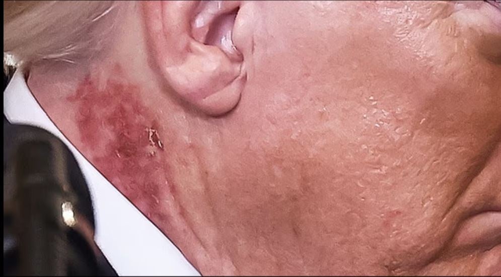 بقعة حمراء متقشرة برقبة ترامب