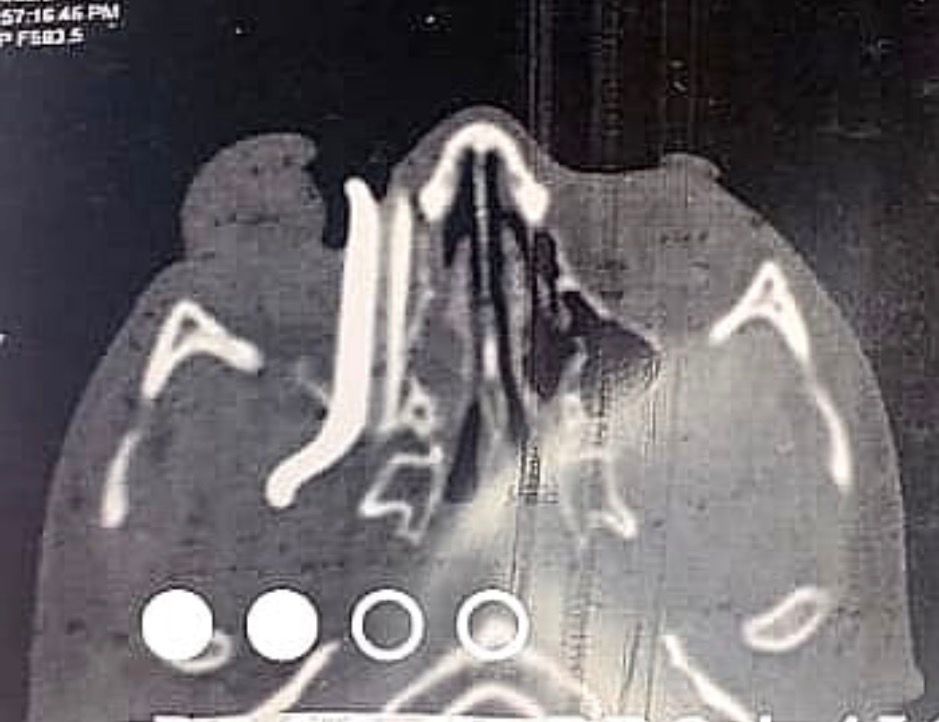 الجسم داخل العين