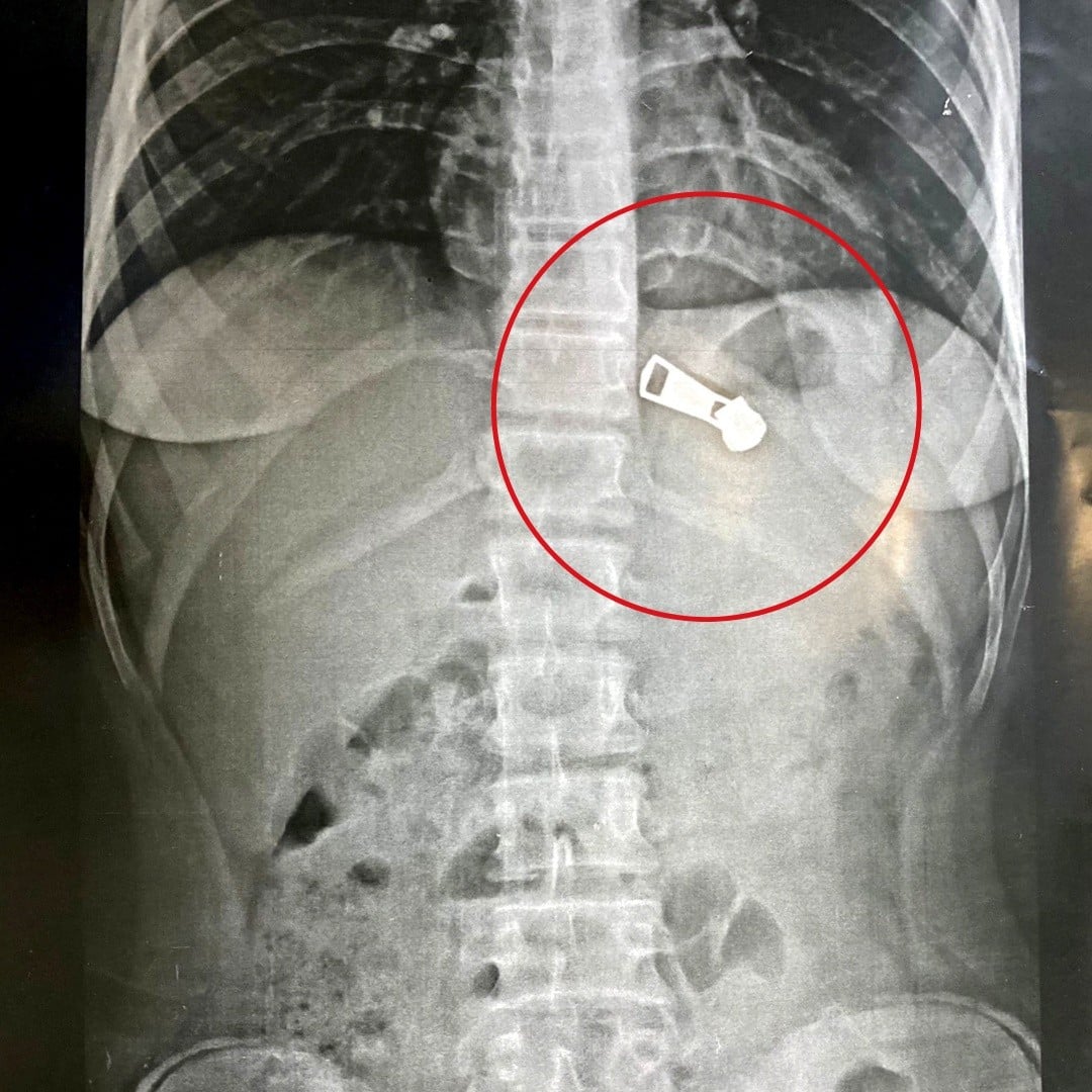 السسته المستخرجة من معدة الطفلة السسته المستخرجة من معدة الطفلة