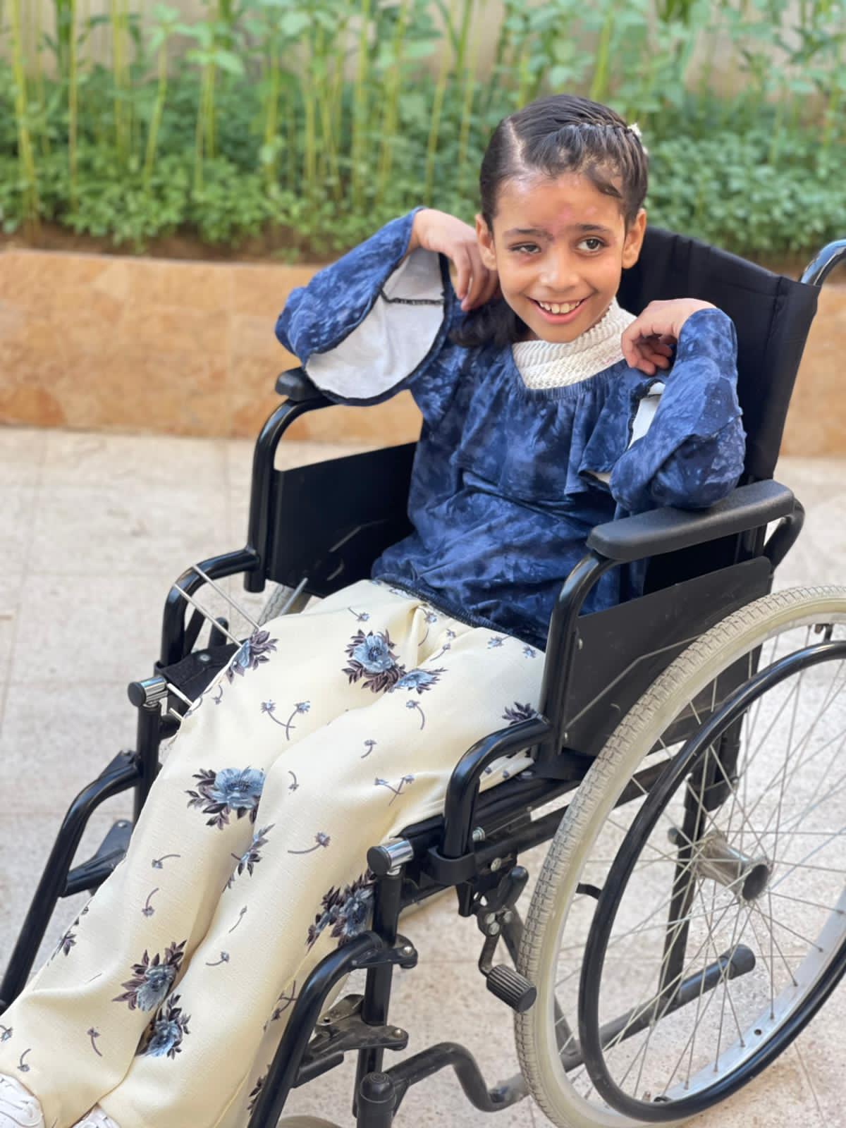 الطفلة جود عظام بعد تعرضها لحروق