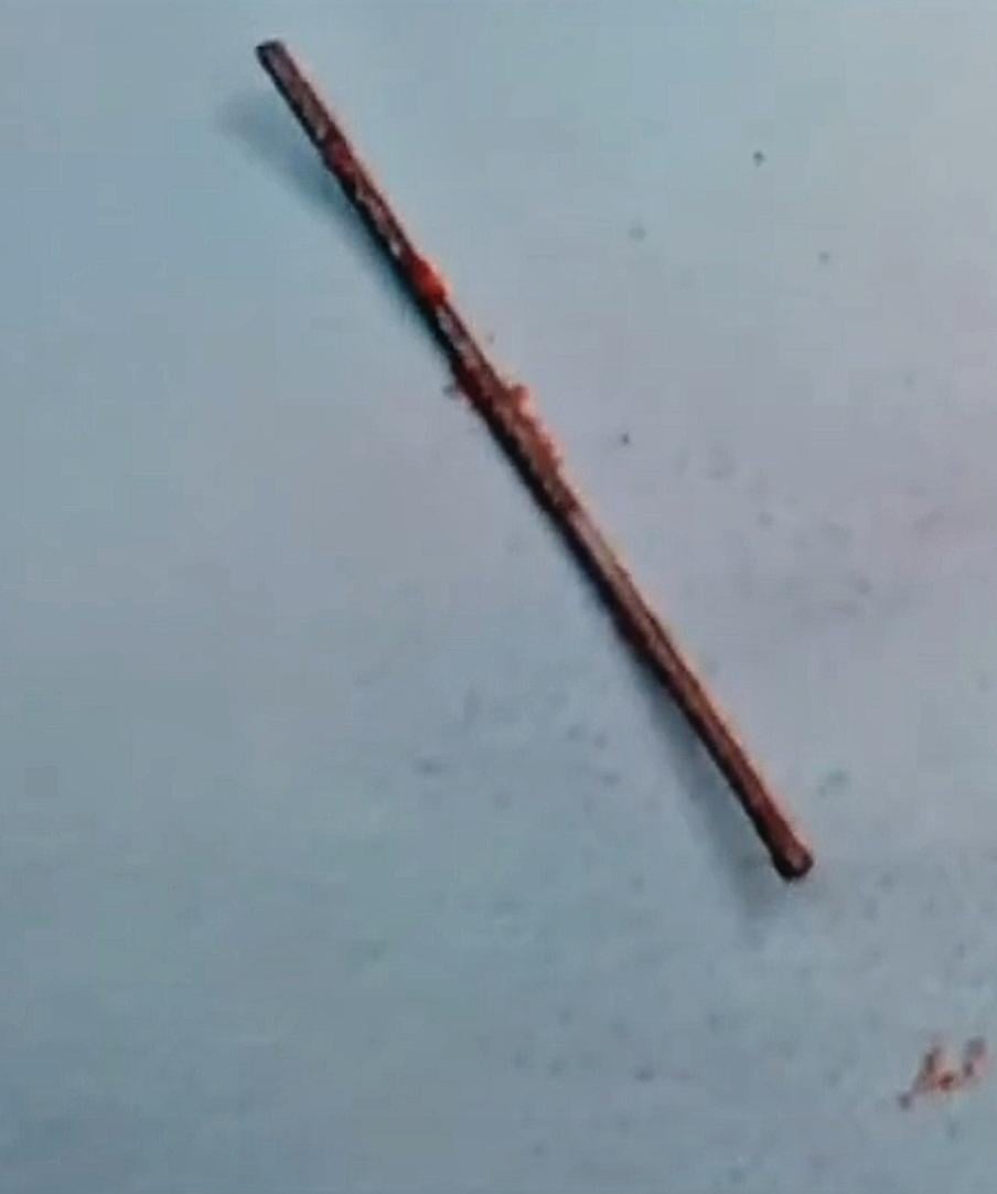 المسمار المستخرج من قلب الطفل