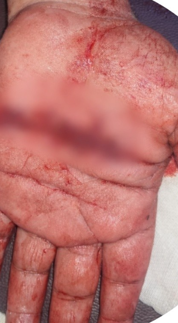 إنقاذ يد مريض من البتر