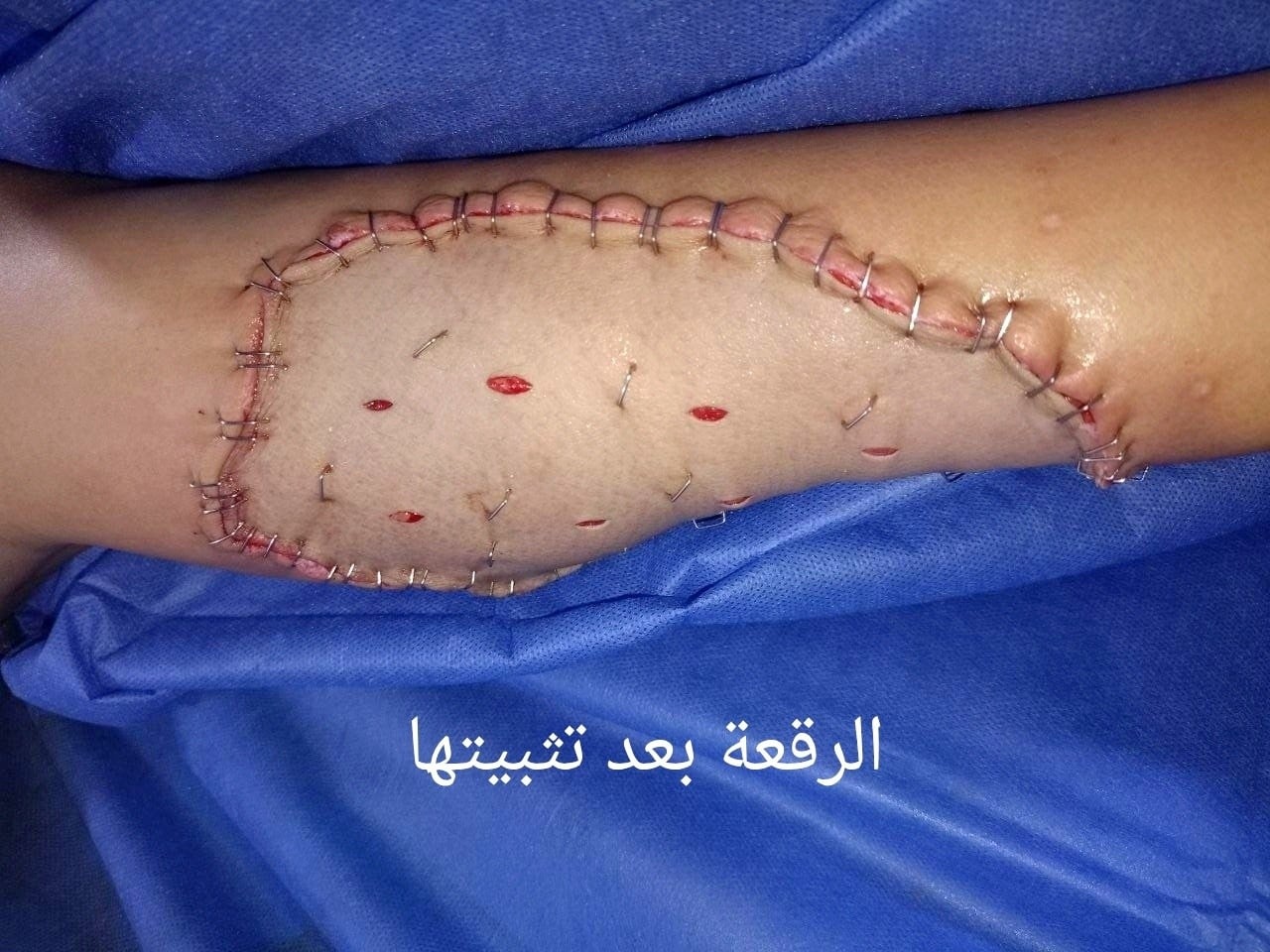 الرقعة بعد تثبيتها