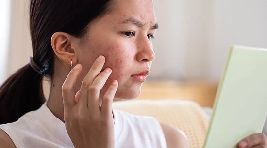 طرق التخلص من حب الشباب طرق التخلص من حب الشباب