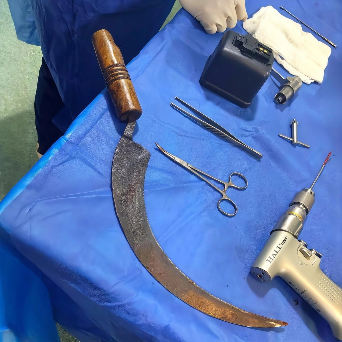 المنجل عقب استخراج جزء منه من قدم الطفل