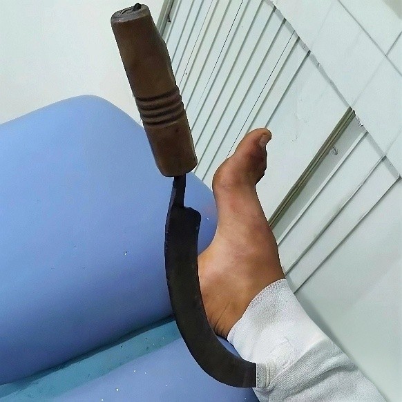 المنجل داخل قدم الطفل