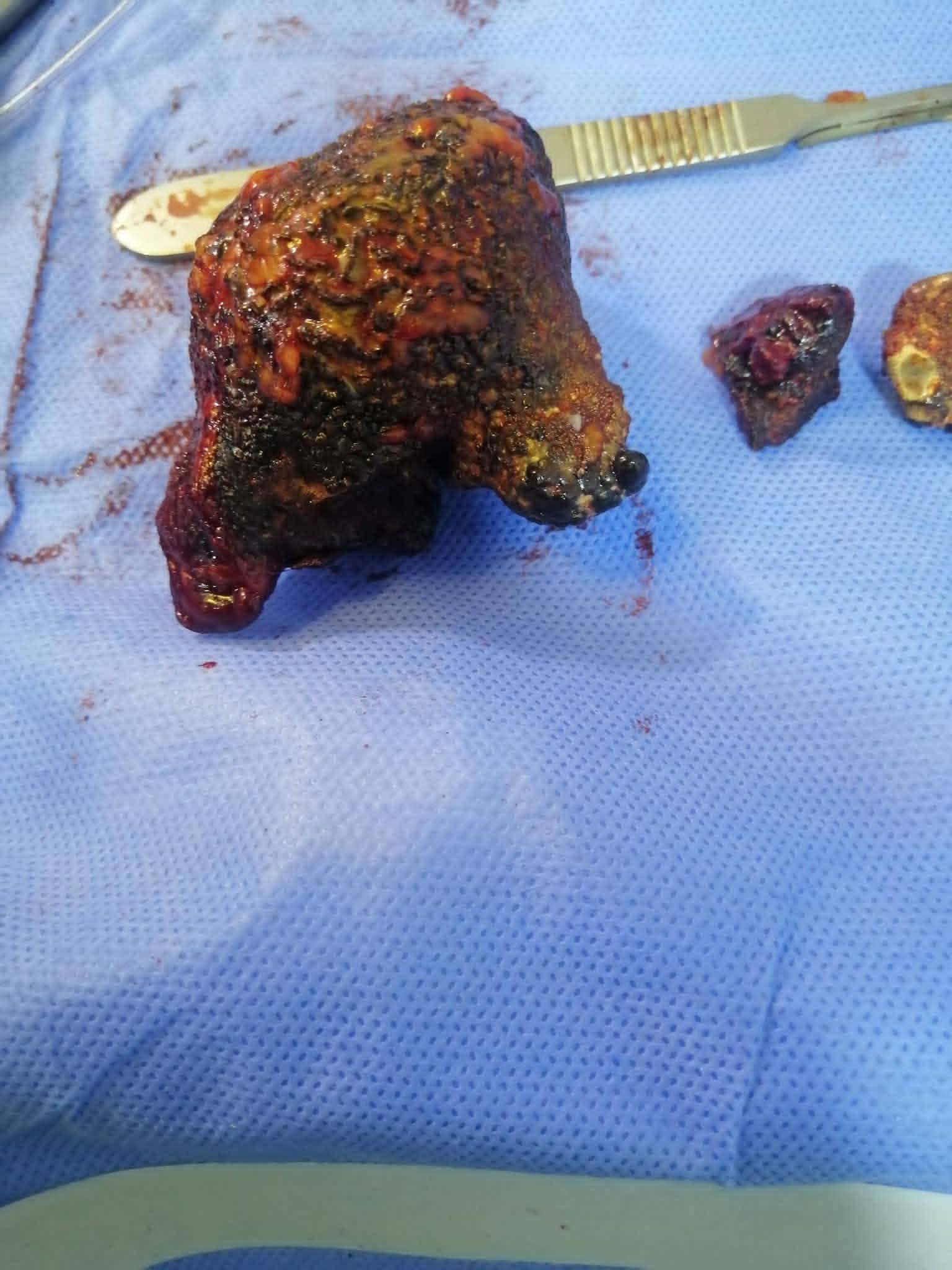 استخراج حصوة وزنها ربع كيلو من مريض في قنا