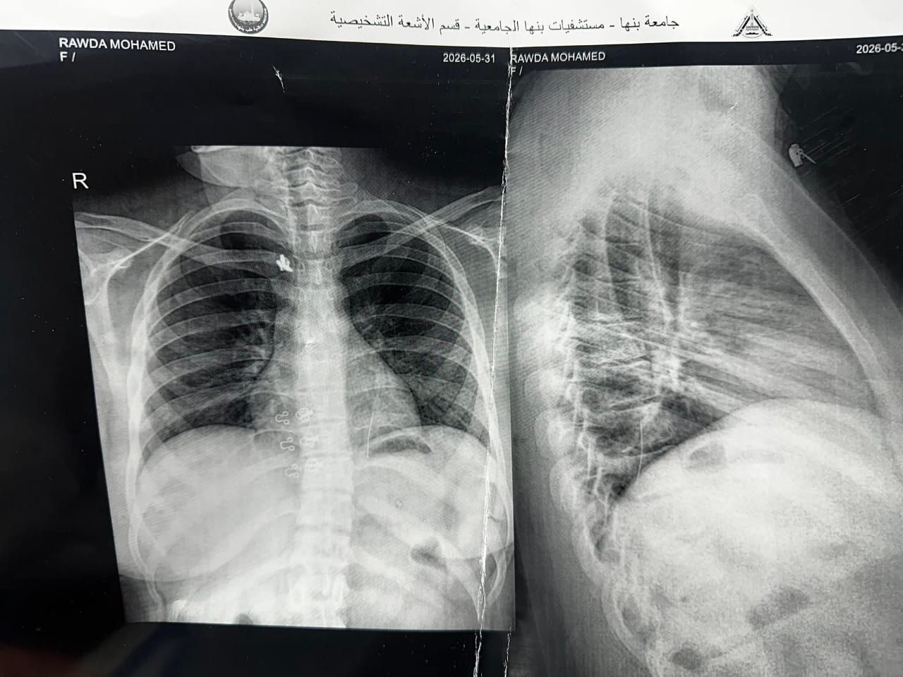 انقاذ حياة طفلة انقاذ حياة طفلة
