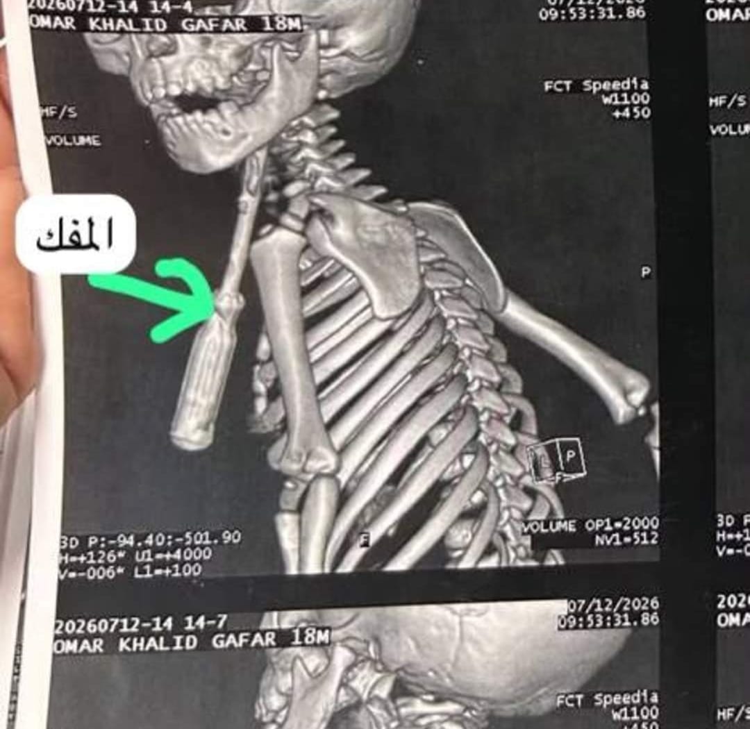 المفك في الرقبة قبل الجراحة المفك في الرقبة قبل الجراحة