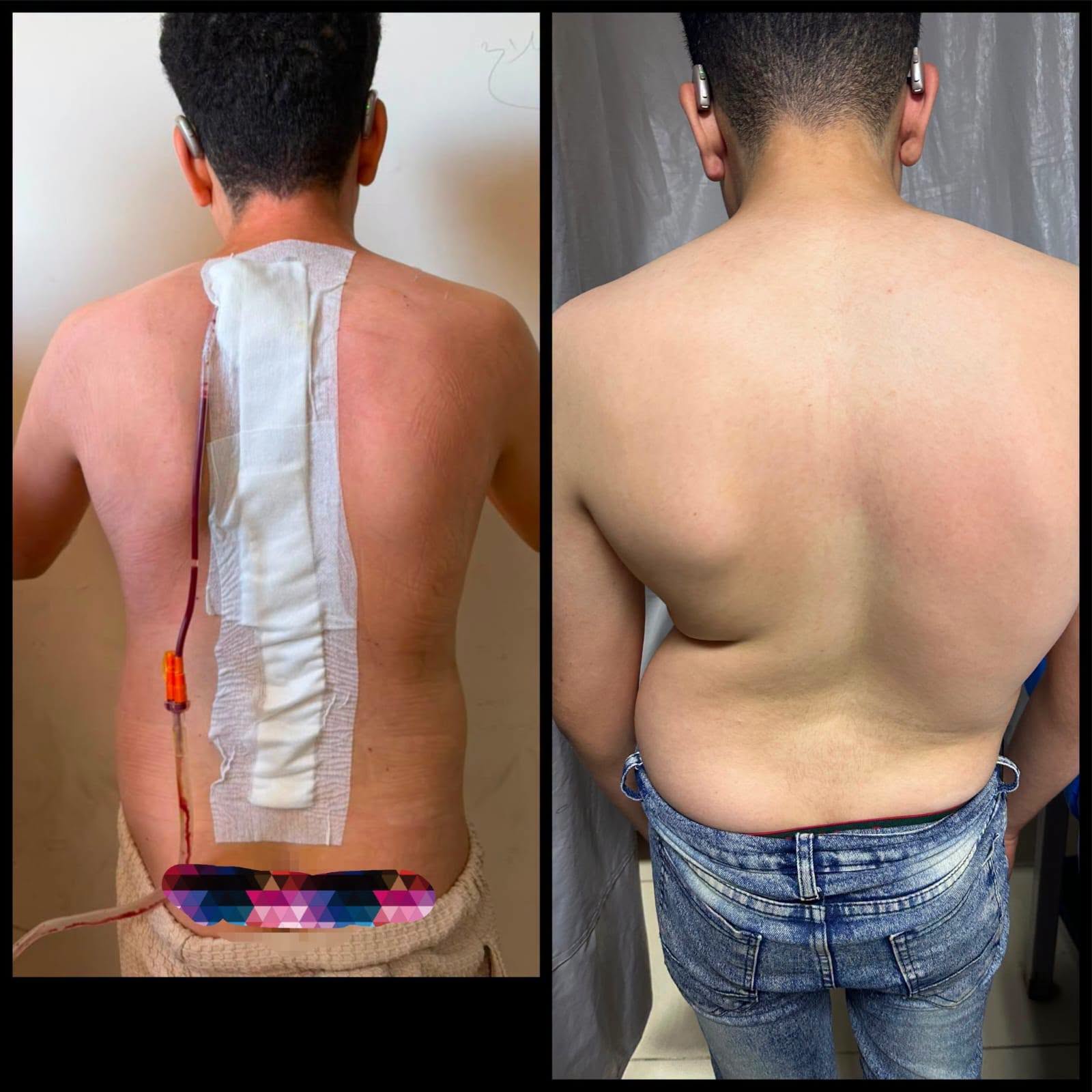 قبل وبعد عملية اصلاح الإعوجاج