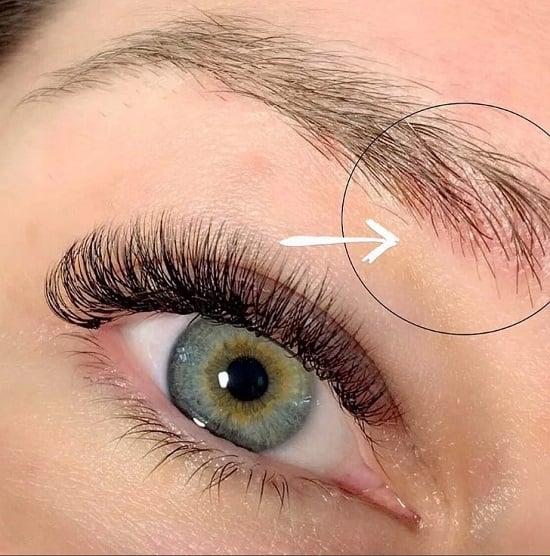 طرق طبيعية لعلاج قشرة الحاجبين