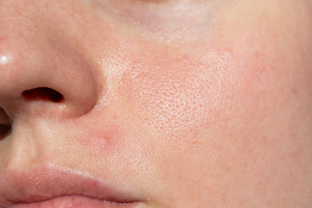 البشرة الدهنية البشرة الدهنية