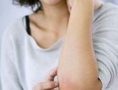 دراسة تكتشف علاجا لاضطراب جلدى نادر