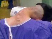 حالة نادرة لمتلازمة الرأس المدلى بسبب المخدرات.. اعرف رأي الطب