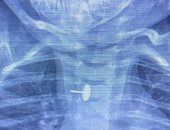 دبوس فى مرئ طفلة بالقليوبية