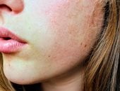 ظهور المسام الواسعة على البشرة 