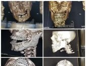 صور الأشعة في جراحة نادرة لطفل بمستشفى دكرنس العام