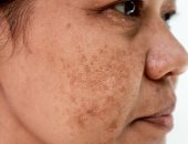 تصبغ البشرة