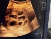 سيدة قنائية تحمل فى 8 توائم بعد 4 سنوات من حرمان الإنجاب