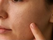 وصفات طبيعية لعلاج مشكلة المسام الواسعة