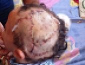 جراحة عاجلة ببنها التعليمي لطفل 4 سنوات يعاني من انقلاع كامل لسمك جزء من فروة الرأس