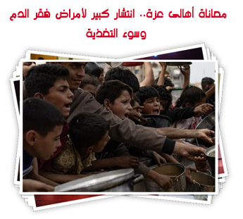 معاناة أهالى عزة.. انتشار كبير لأمراض فقر الدم وسوء التغذية
