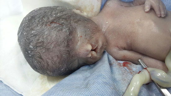 طفل بدون عيون، اخبار الصحة، حالة نادرة، عيوب خلقية (1)