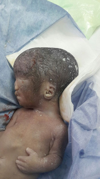 طفل بدون عيون، اخبار الصحة، حالة نادرة، عيوب خلقية (2)