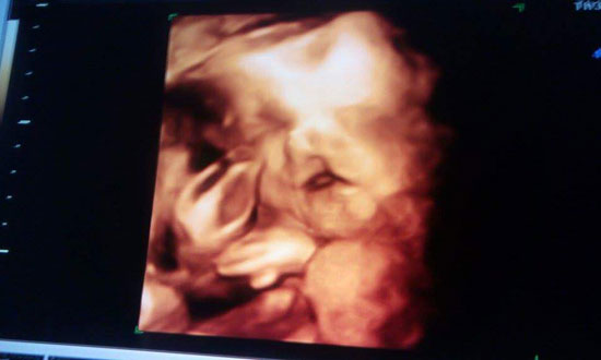 طفل بدون عيون، اخبار الصحة، حالة نادرة، عيوب خلقية (4)