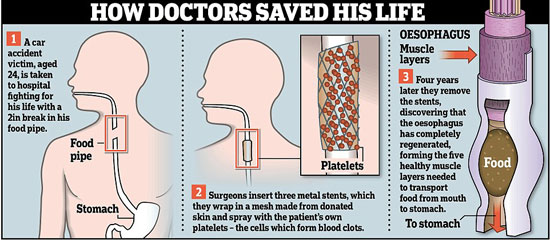 أجريت لشاب تعرض لحادث.. تفاصيل أول عملية ناجحة فى العالم لزراعة البلعوم أجريت لشاب تعرض لحادث.. تفاصيل أول عملية ناجحة فى العالم لزراعة البلعوم