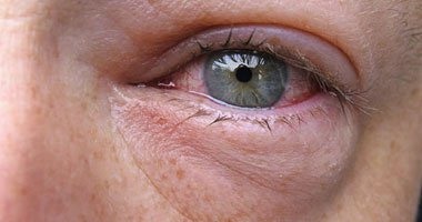 أخصائية باطنة توضح أسباب تضخم العينين عند الاستيقاظ وكيفية علاجها
