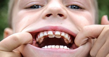 طفل بريطانى فى الثامنة يعانى من حالة "أسنان القرش"
