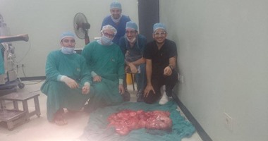 استئصال ورم يزن 45 كيلو من بطن مريض فى مستشفى الأورام بجامعة المنصورة