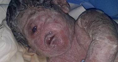 بالصور. ولادة نادرة لطفل بالسنبلاوين بعين واحدة