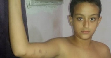 صحافة المواطن.. بالصور.. معلمة تعتدى على طالب بالضرب المبرح بالسويس 