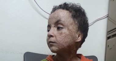 بعد نشر"اليوم السابع"مأساة طفل حوله حريق منزله إلى "شبح".. الاستجابات تتوالى