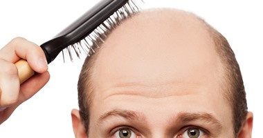 علماء يتوصلون إلى أسباب تساقط الشعر عند الرجال وراثيًا