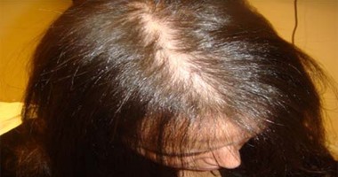 تعرف على أهم 5 أسباب لحدوث الصلع وتساقط الشعر