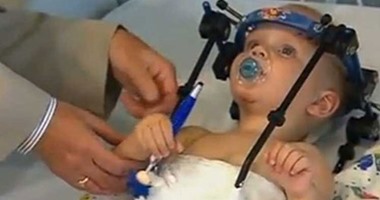 بالفيديو.. معجزة طبية.. إعادة توصيل رأس طفل انفصل فى حادث سيارة