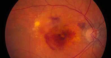 اسباب اصفرار العين مشاكل فى الكبد