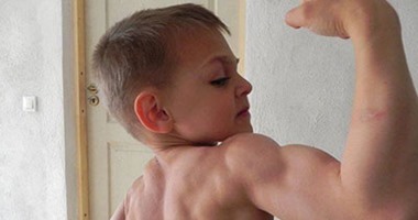 تعرف على أنواع العلاجات المختلفة لمرض ضمور العضلات عند الأطفال