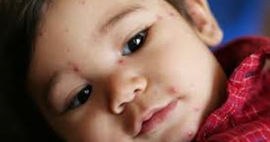 5 أسباب وراء إصابة الأطفال بالطفح الجلدى.. تعرف عليها 