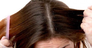 طرق طبيعية للتخلص من قشرة الشعر فى الشتاء أهمها استخدام الخل