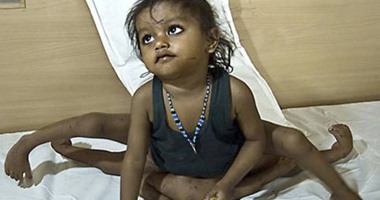 الطفلة الأخطبوط تحتاج جراحة تصحيحية لسد التسرب مكان الأطراف المقطوعة