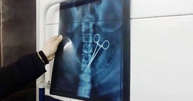 بالصور.. طبيب ينسى "مقص طبى" داخل أمعاء مريض بعد عملية استئصال ورم