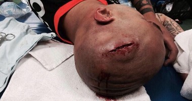 بالفيديو.. إصابة قاتلة فى رأس مهاجم باتشوكا المكسيكى