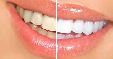 7 نصائح ضرورية للتخلص من اصفرار الأسنان
