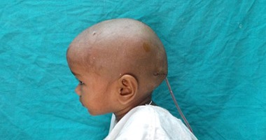 بالصور.. علاج طفلة هندية من ورم نادر بحجم كرة القدم فى الرأس