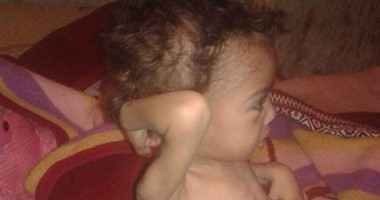 صحافة المواطن.. أسرة طفل مصاب بتضخم الطحال تطالب بعلاجه على نفقة الدولة